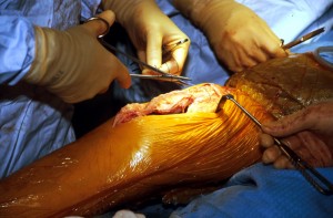 KNEE REPLACEMENT OPERATION, BRITAIN VARIOUS