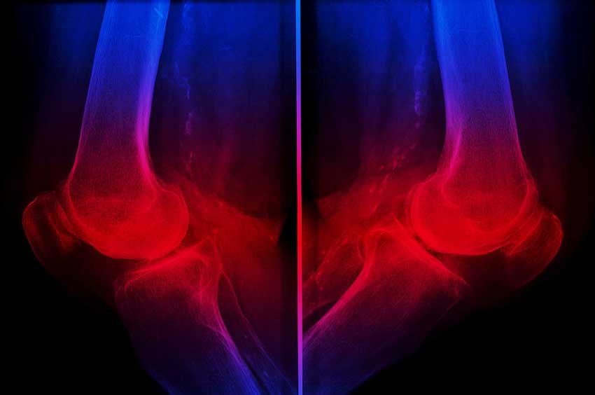 The role of the rheumatoid factor