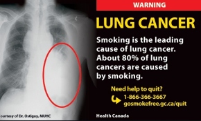 can we smoke cigarette after fistula surgery Complex Anal Fistula for Smoking and Tobacco